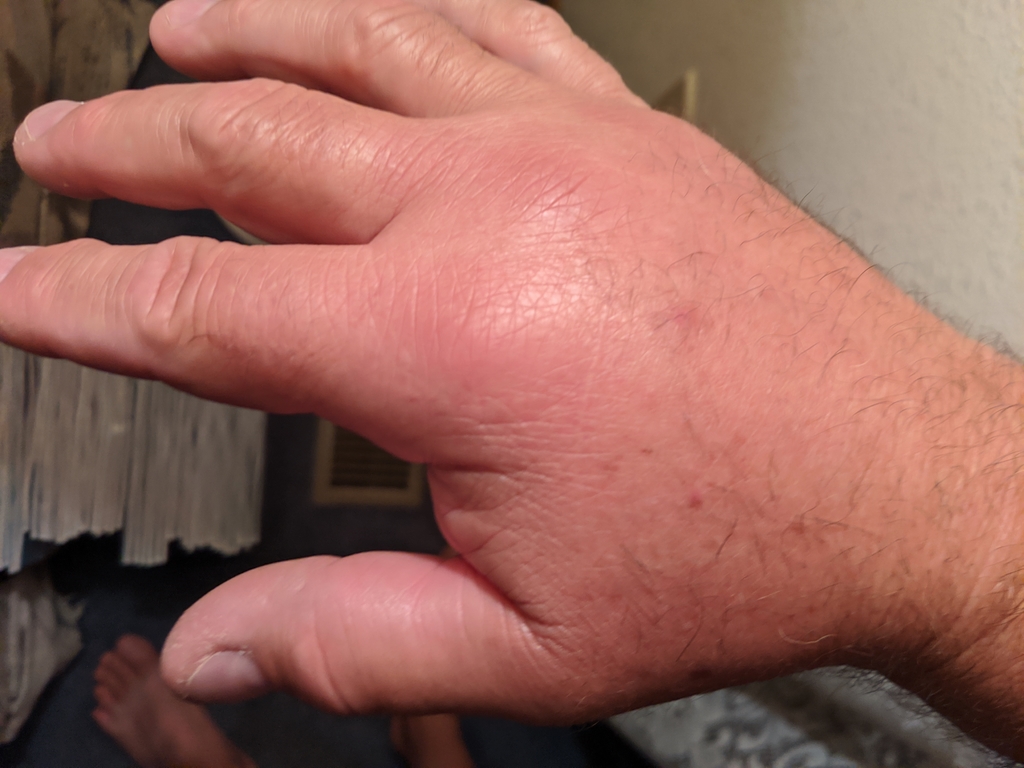 0722_SwollenHand.jpg