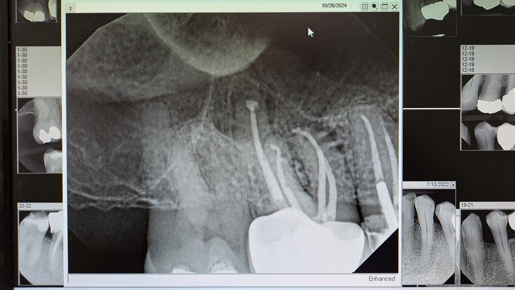 1026_MolarXRayNextDay.jpg